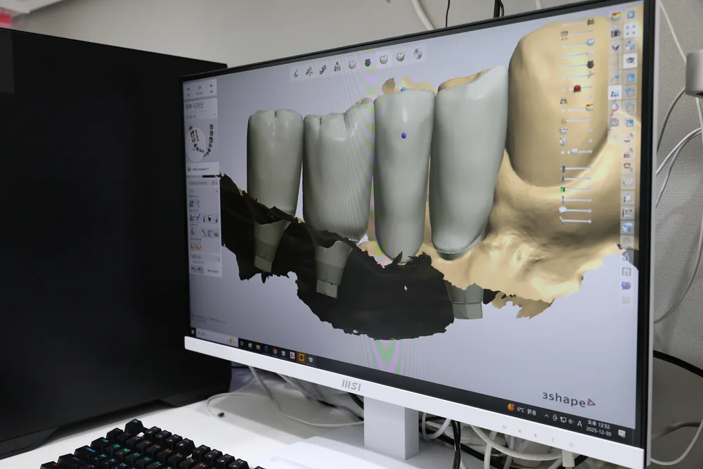 원내 기공실 CAD 보철 설계 모니터 — 3Shape 디지털 디자인
