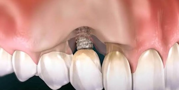 Why Is My Dental Implant Loose?